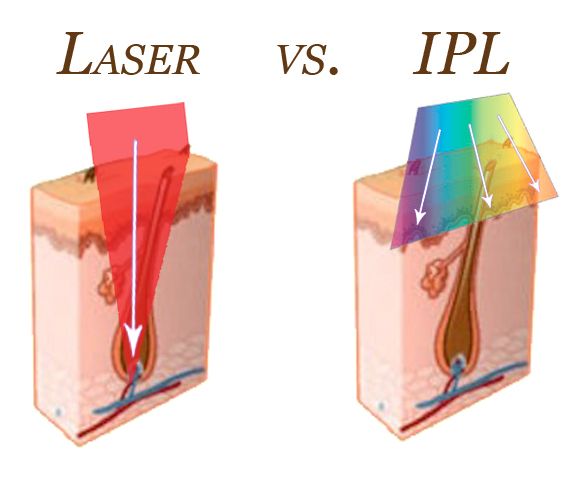 Laser-vs-IPL-article-image1