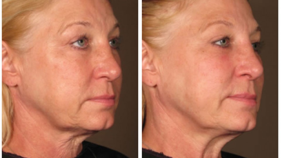Ultherapy-before-after-full-face-1