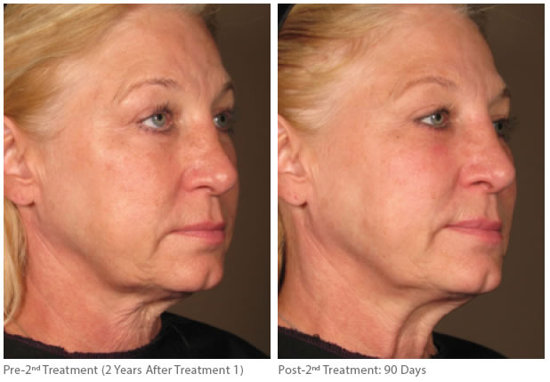 Ultherapy-before-after-full-face-1