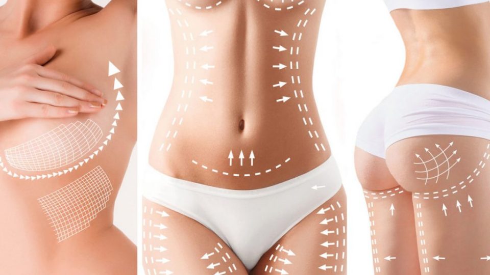 The cellulite removal plan. White markings on young woman body