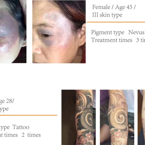 Q-Switch Nd:YAG Laser